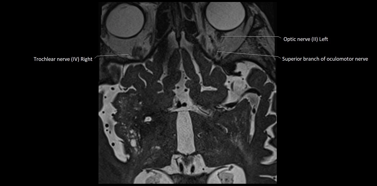 Cranial nerve anatomy axial MRI 3T image 1.webp